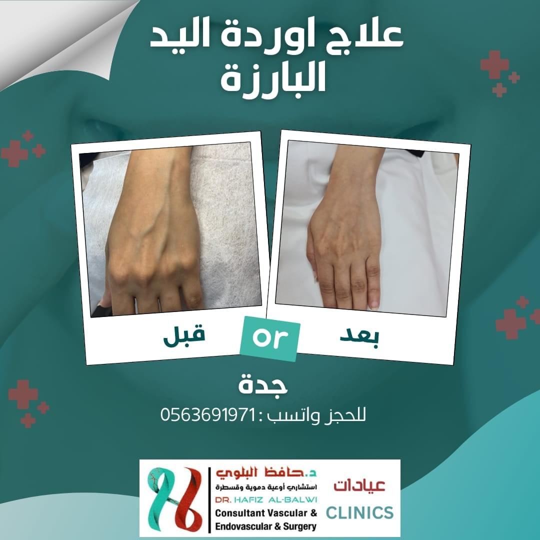 إزالة اوردة الكف البارزة