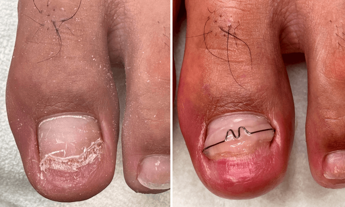 耐恩適維持器-合作店家案例-劉先生