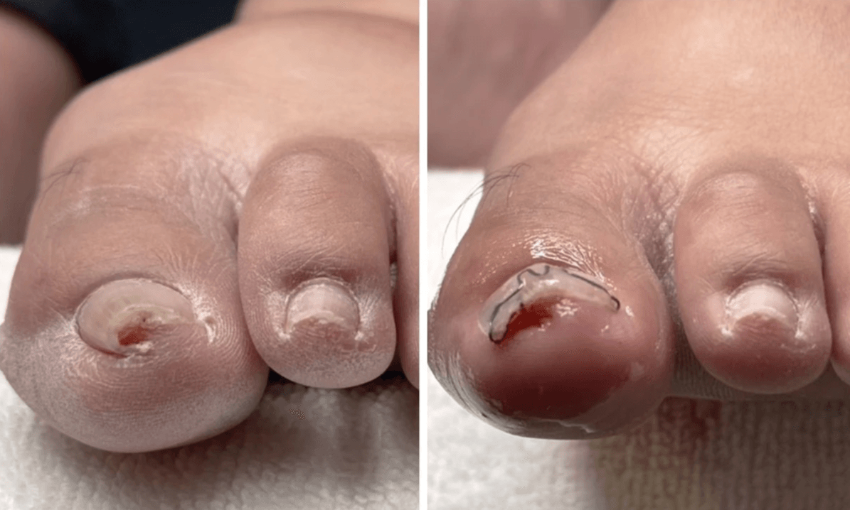 耐恩適維持器-合作店家案例-李小姐