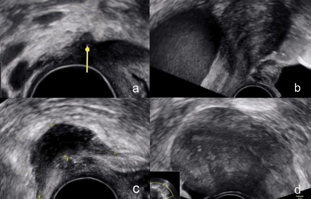 Endometriose-Diagnostik Ultraschall Bern GynaeXcellence