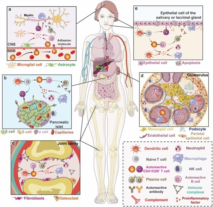 Pattern Diagram of Some Common Autoimmune Diseases  a. Mechanism Diagram of Multiple Sclerosis (MS) Autoreactive T cells are like "immune soldiers that have targeted the wrong enemy". They sneak into the central nervous system through the adhesion molecules on the blood-brain barrier, trigger local inflammation, gradually damage the "protective sheath" of the nerves (myelin sheath), and also lead to the apoptosis of neuronal cells. b. Mechanism Diagram of Type 1 Diabetes (T1D) Dendritic cells are equivalent to the "commanders" of the immune system. They mistakenly induce the production of autoreactive T cells, which trigger local inflammation in the pancreas, kill the pancreatic β cells responsible for regulating blood sugar, and ultimately cause problems with glucose metabolism. c. Mechanism Diagram of Rheumatoid Arthritis (RA) After dendritic cells activate autoreactive T cells, the immune cells in the joint cavity "lose their bearings", and fibroblasts also proliferate wildly. The autoantibodies released by B cells form immune complexes, which further intensify local inflammation, and eventually lead to the apoptosis of osteocytes and damage to bones and joints. d. Mechanism Diagram of Systemic Lupus Erythematosus (SLE) This disease is most likely to "attack" the kidneys, and its pathogenesis is very similar to that of rheumatoid arthritis~ Immune complexes and complement, these "troublemakers", deposit in the glomeruli, trigger inflammation, and finally damage kidney function. e. Mechanism Diagram of Sjögren's Syndrome (SS) The "trouble-making routine" of its immune cells is similar to that of the above-mentioned diseases, but instead of wandering around the whole body, it specifically "targets" the salivary glands and lacrimal glands, leading to the apoptosis of glandular epithelial cells. In the end, dry mouth and dry eyes occur, and the glands gradually lose their function. Song, Y., Li, J. & Wu, Y. Evolving understanding of autoimmune mechanisms and new therapeutic strategies of autoimmune disorders. Sig Transduct Target Ther 9, 263 (2024). https://doi.org/10.1038/s41392-024-01952-8