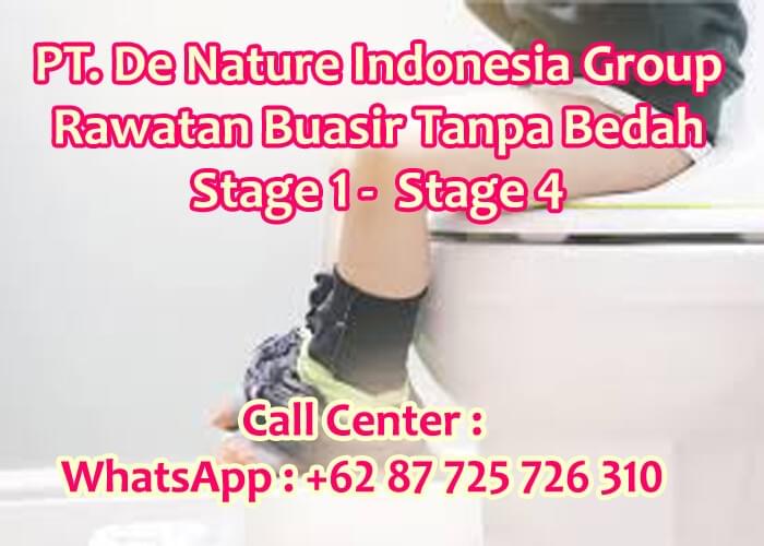 Inilah Ubat Hilangkan Bengkak Buasir Paling Dipercayai