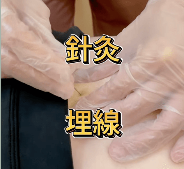 本師堂埋線減重實測照