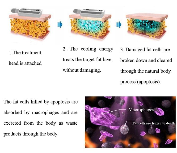 Vertical Ice Sculpting + Cryopad Body Slimming System