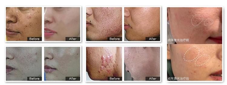 Vertical Fractional CO2 Laser Skin Care System