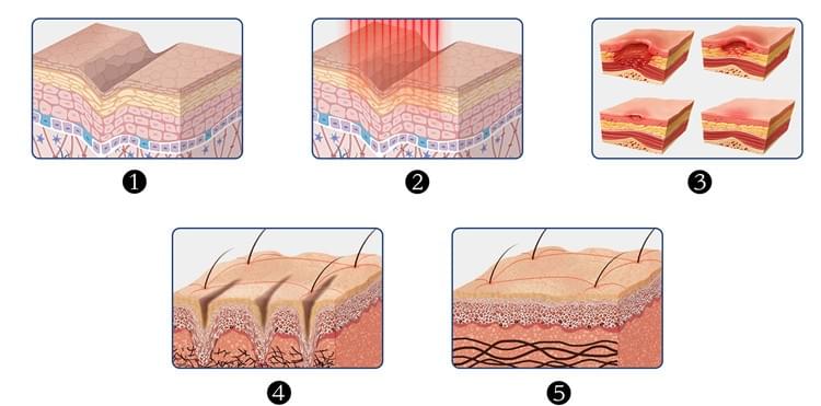 Vertical Fractional CO2 Laser Skin Care System