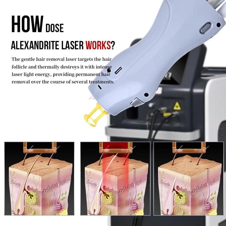 Alexandrite Laser Hair Removal Device A800