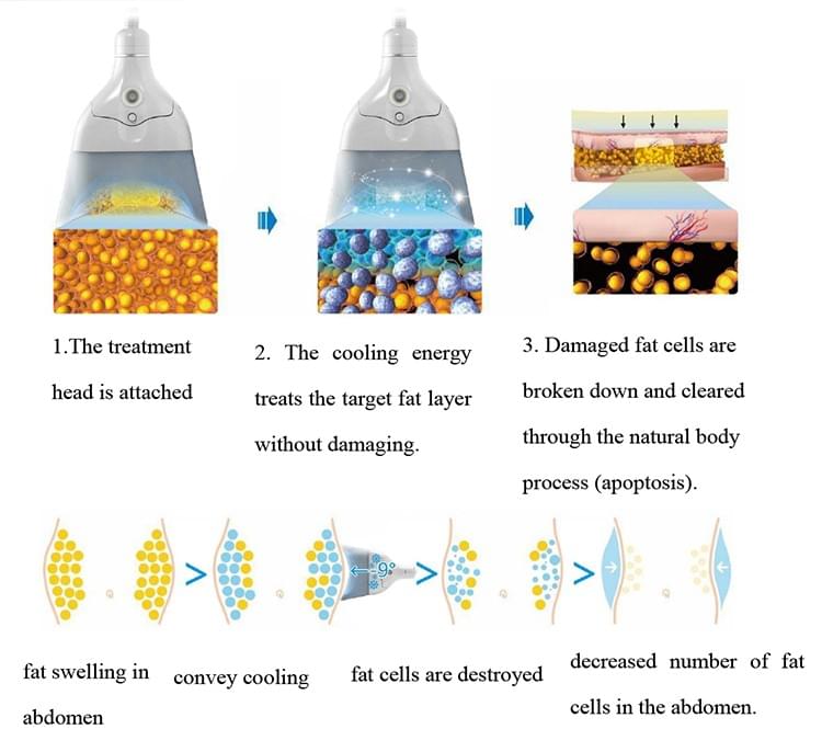 Vertical Ice Sculpting + Cryopad Body Slimming System