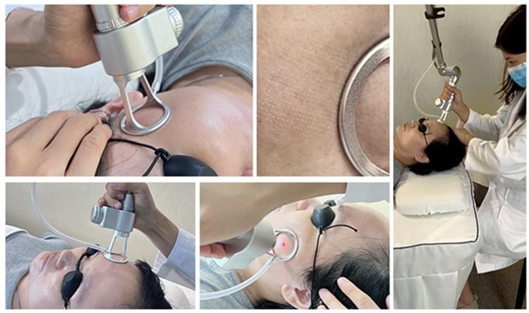 Vertical Fractional CO2 Laser Skin Care System