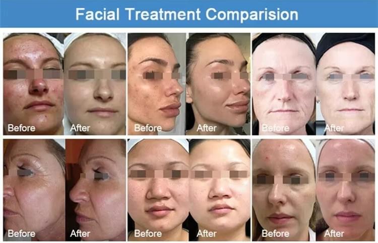 O2toDerm Skin Care System