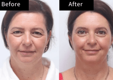 Perfecting your facial harmony is our goal. Our rhinoplasty and facial feature surgeries are designed to improve proportion and symmetry, helping you look and feel your best. Trust our experienced team for natural, stunning results. Nose & Facial Features Our Cosmetic Surgery Services 主要做整形手术
