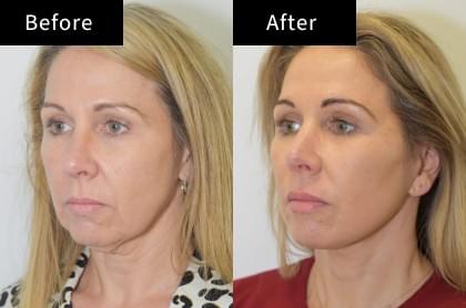 Looking to refresh your appearance? Our expert surgeons specialize in facelift and eyelid procedures that can give you a youthful, vibrant look. We focus on natural results tailored to your features, making sure you feel confident and comfortable in your skin. Facelift & Eyelid Surgery Our Cosmetic Surgery Services 主要做整形手术