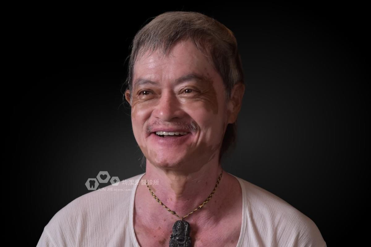 均潔牙醫診所，All on 4植牙案例