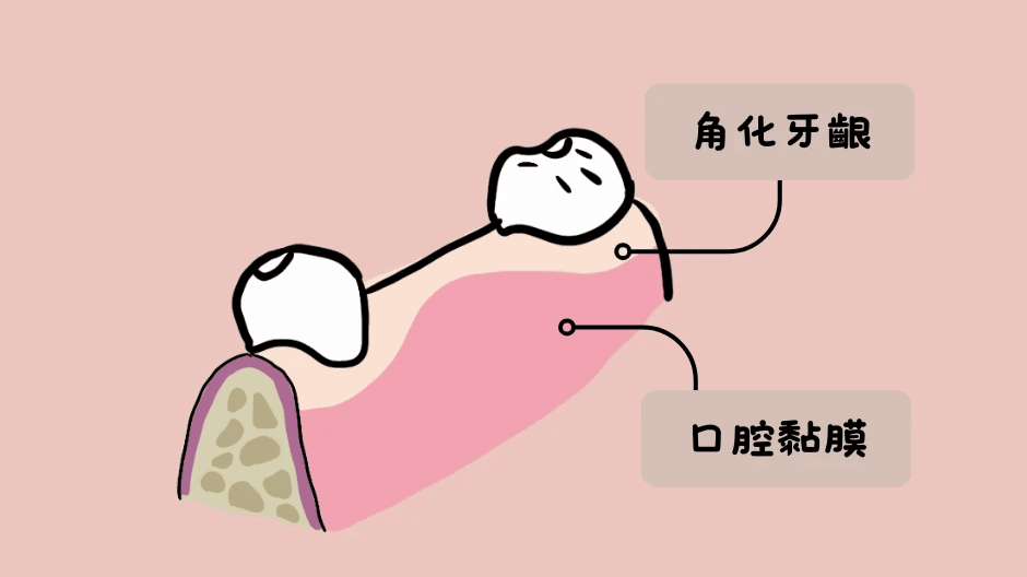 角化牙齦和口腔黏膜