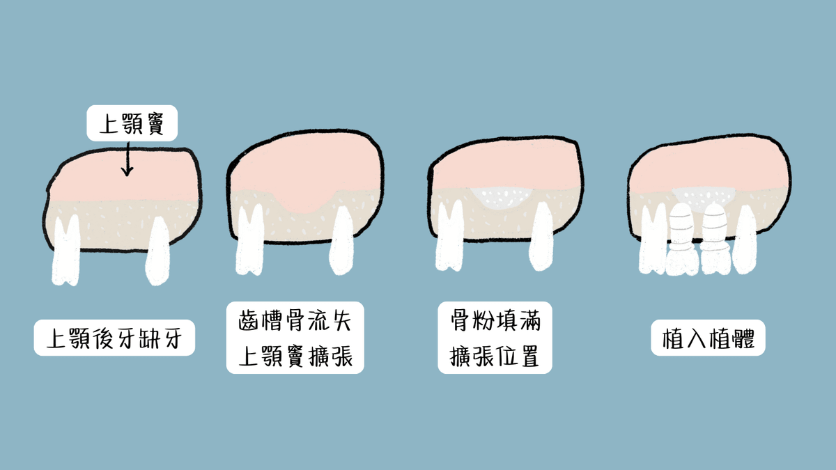鼻竇增高術原理示意圖