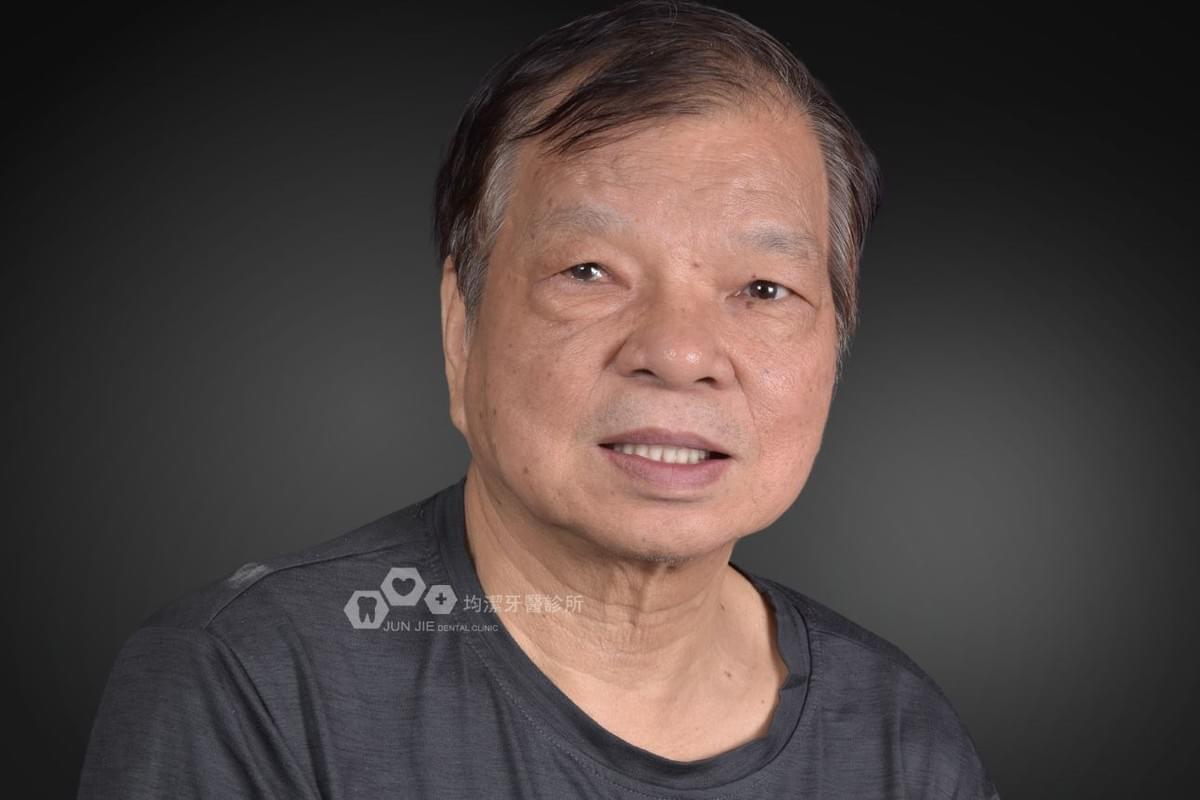 均潔牙醫診所，All on 4植牙案例