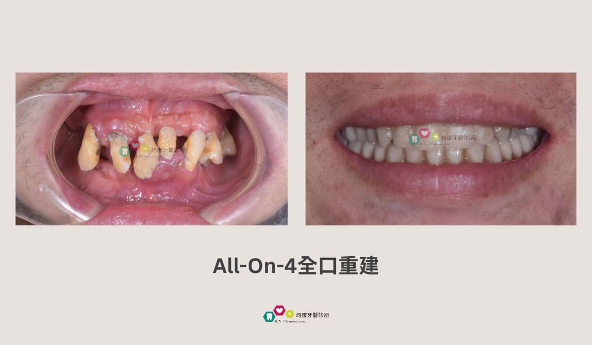 均潔牙醫診所，All on 4植牙案例