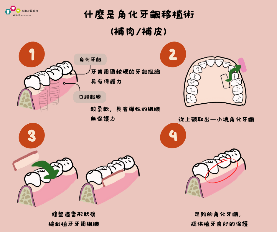 什麼是角化牙齦移植術