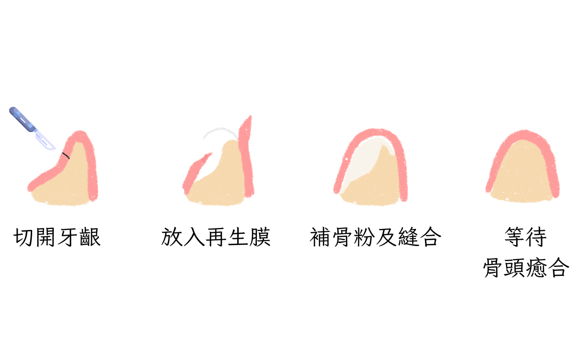 水平補骨原理示意圖