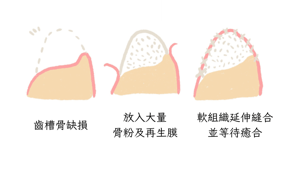 垂直補骨原理示意圖