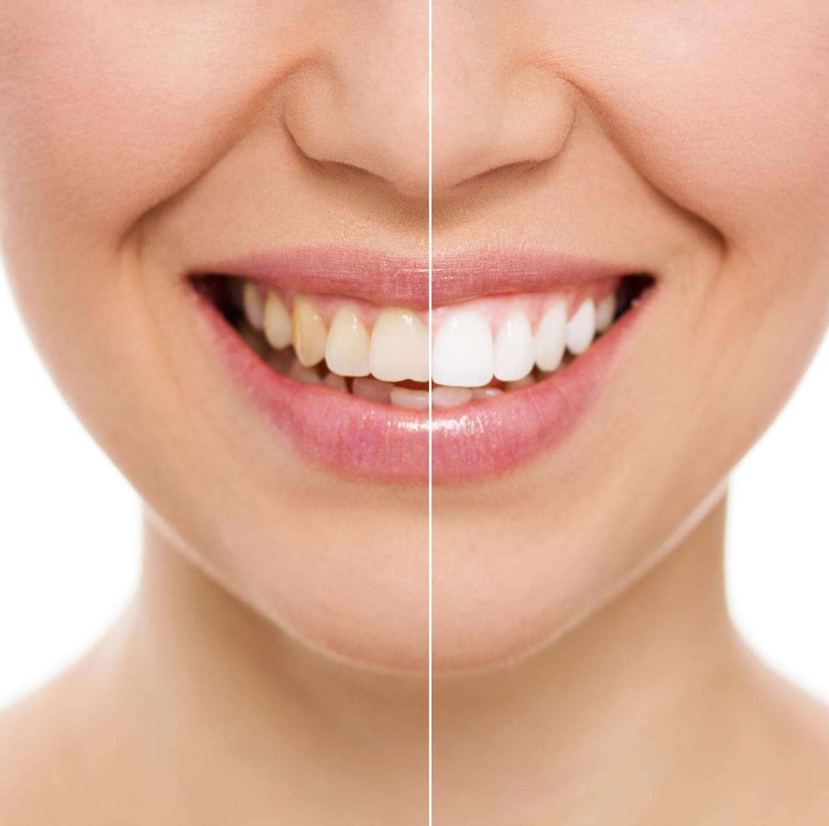 Brighten Up Your Pearly Whites How to Use Whitening St...