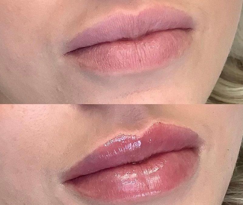 Know about Best Lip Filler and Lip Doctor in Dubai