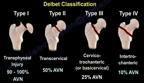 AVN of the Femoral Head- Causes, Trauma to the Hip - He...