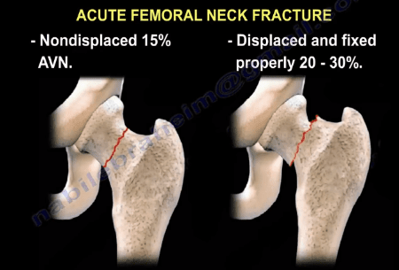 AVN of the Femoral Head- Causes, Trauma to the Hip - He...