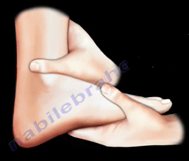 Lahrmets Sign Conditions Affecting the Cervical Spine - Orthopedic Su...