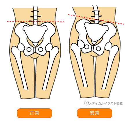 身体の歪みは不調の印 - 骨盤矯正 身体の歪み お役立ちブログ