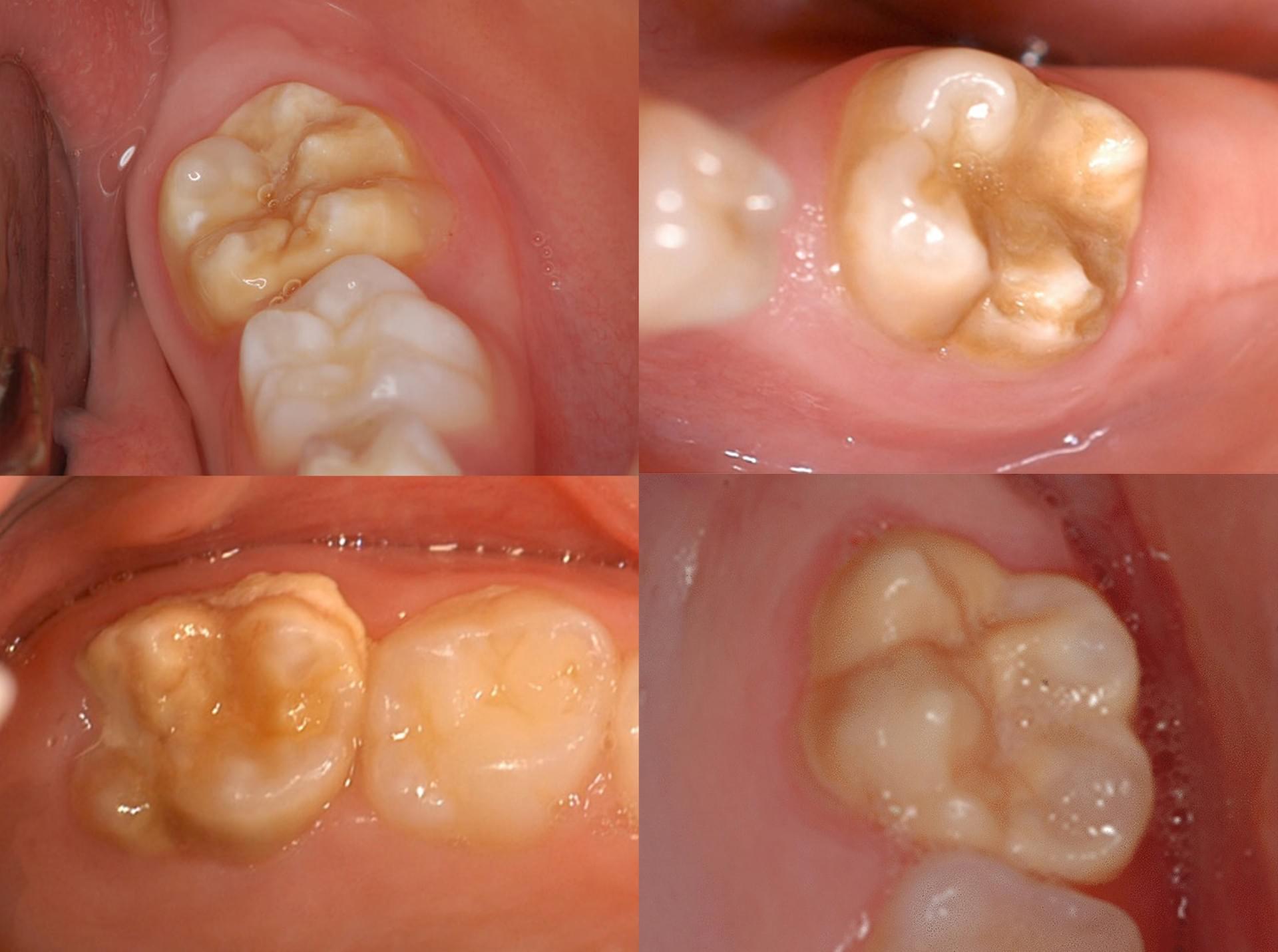 Dentisterie pédiatrique