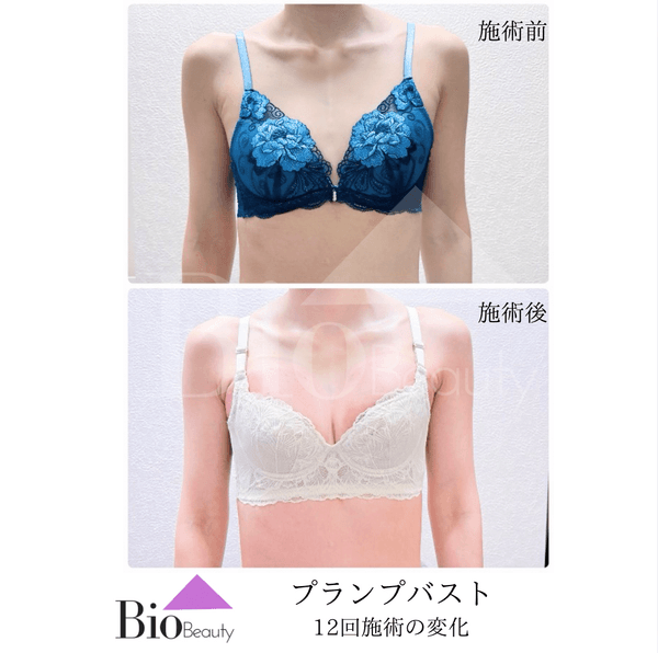 プランプバスト 12回施術の変化