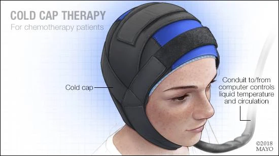 cold cap for cancer patients preserving hair during chemotherapy cold cap for cancer patients preserving hair during chemotherapy